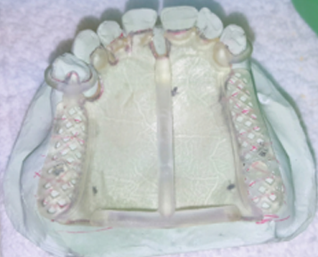 3D打印助力牙科实验室增加产能