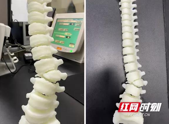 长沙市中医医院：3D打印技术助力脊柱侧弯少女“挺直腰杆”