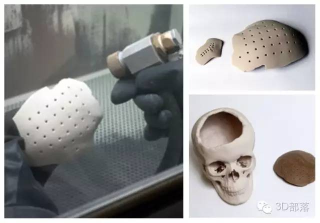 可被人体吸收的3D打印聚合物颅骨植入物