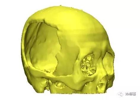 【实战案例】利用3D打印进行颅骨修复