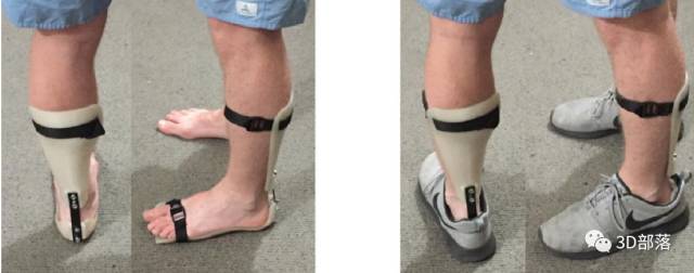 【案例分享】3D打印定制集成碳纤维弹簧铰链的足踝矫形器的研究