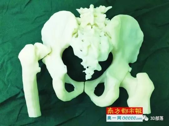 【南方医科大学深圳医院】数字骨科3D打印精准技术助患者治疗42年顽疾