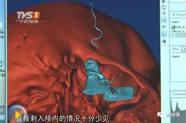 广州妇女儿童医疗中心3D打印帮助患儿“补脑洞”