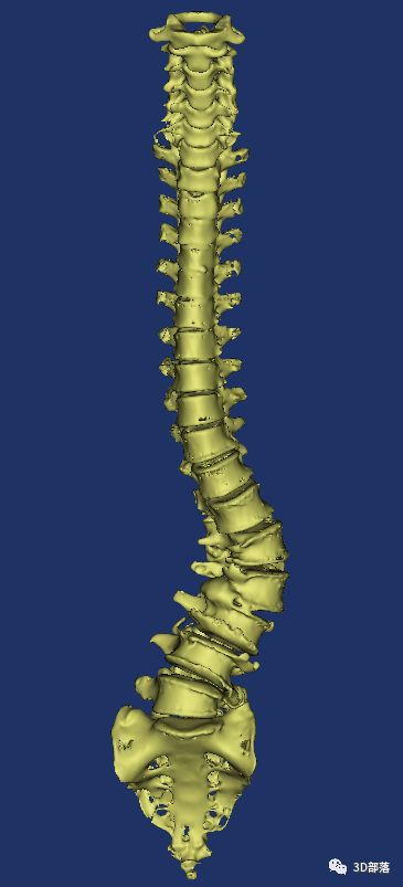 3D打印技术解脊柱侧弯助“身直” 哈医大一院数字骨科再造患者新生
