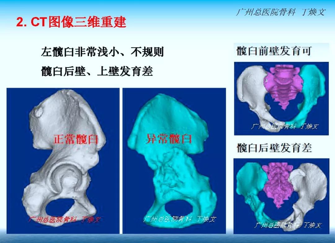 【案例分享】广总丁焕文：DDH全髋置换手术三维设计与术中术后总结