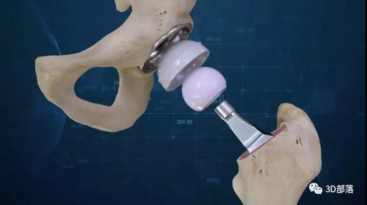 3D打印技术应用于关节置换术的现状及问题对策探讨