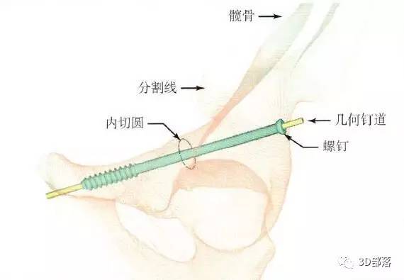 【实战案例】髋臼前柱顺行拉力螺钉固定钉道的有限元研究