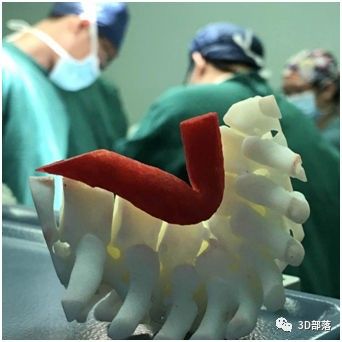三的部落3D打印助力脊柱后凸矫正手术术前规划