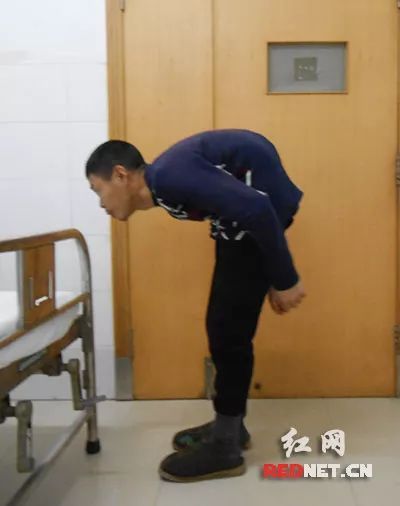 湖南一男子脊柱弯曲90度 3D打印技术助其“抬头看天”